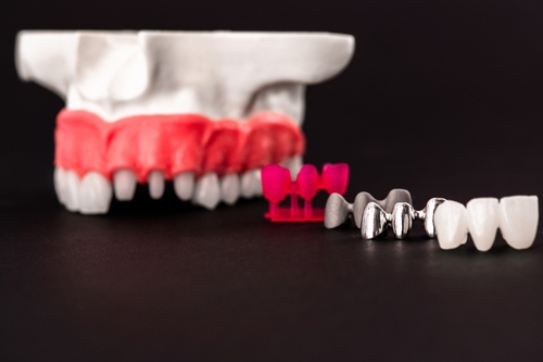 Everything About Dental Crowns - JSOI